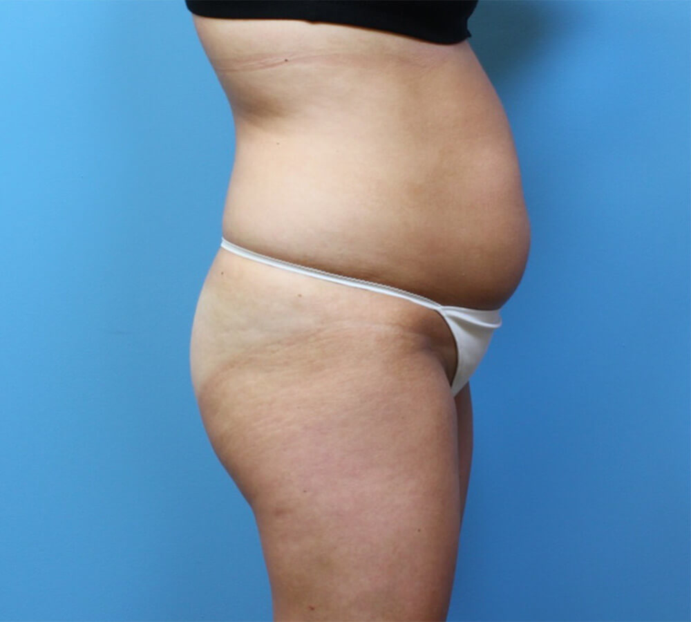 Brazilian-Butt-Lift-Case--265 | Before Brazilian Butt Lift 3