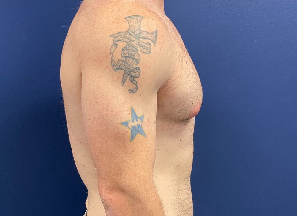 Gynecomastia-Case--28230 | Before Gynecomastia / Male Breast Reduction 5