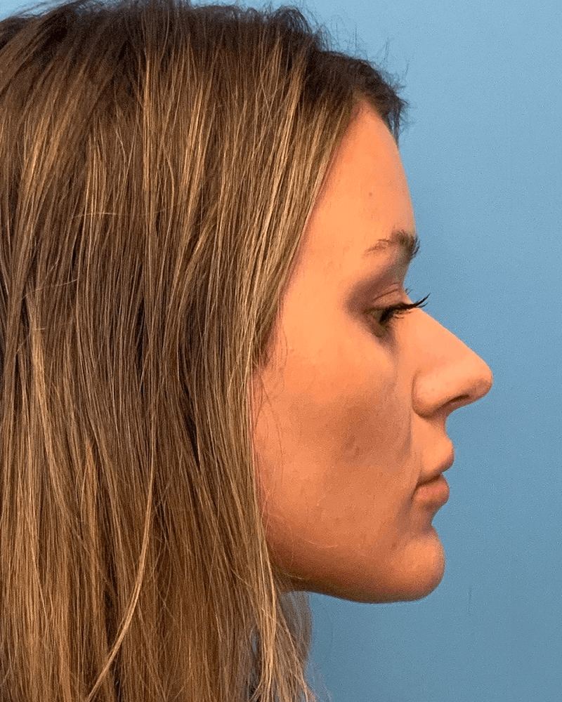 Rhinoplasty-Case--23703 | Before Rhinoplasty 5