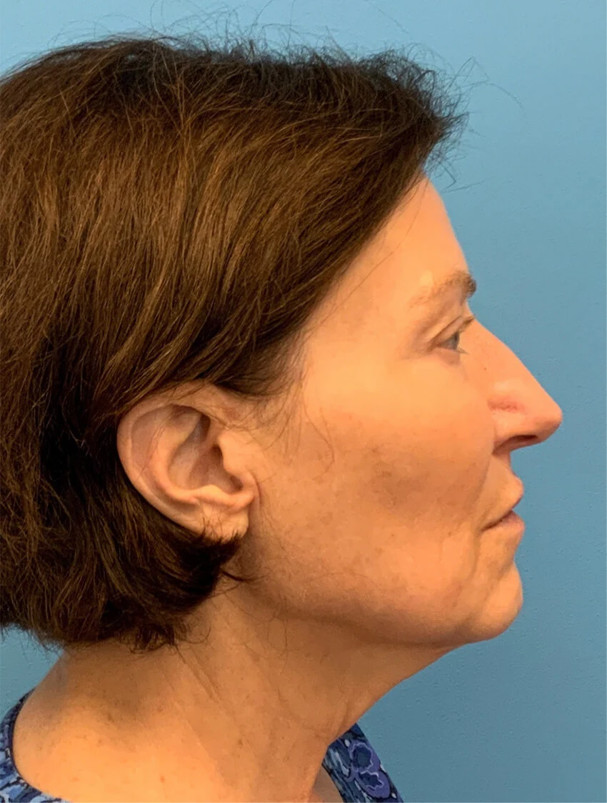 Case--9966 | Before Facelift 5