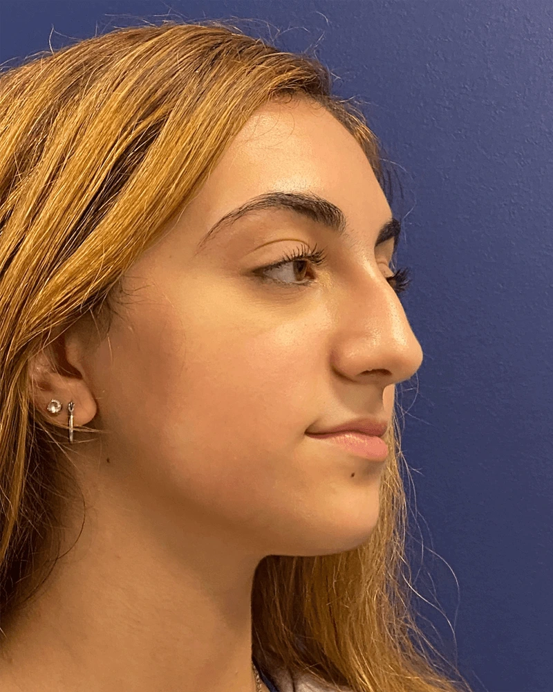 Rhinoplasty-Case--23921 | Before Rhinoplasty 4