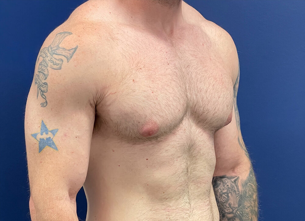 Gynecomastia-Case--28230 | Before Gynecomastia / Male Breast Reduction 4