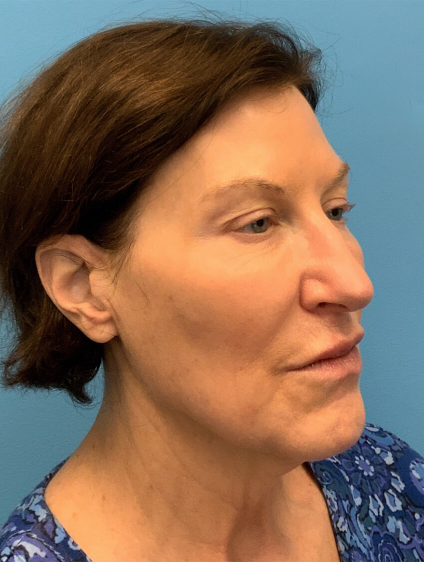 Case--9966 | Before Facelift 4