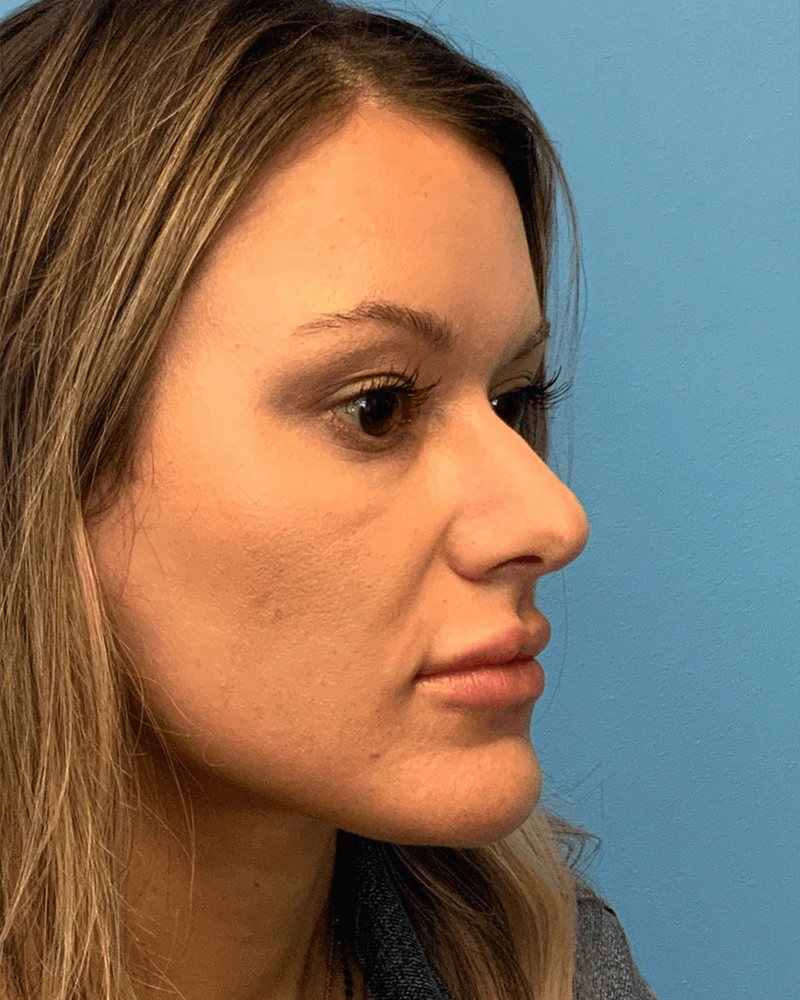 Rhinoplasty-Case--23703 | Before Rhinoplasty 6