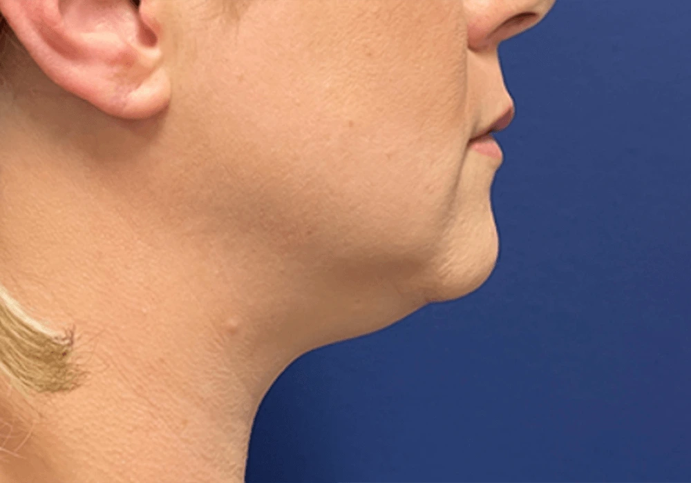 Case--20811 | Before Submental Liposuction 2