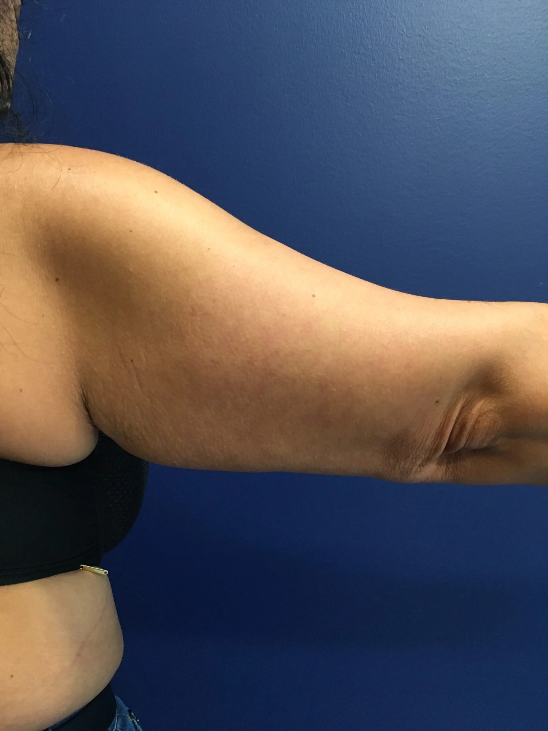 Brachioplasty-Case--1162 | Before Arm Lift 5