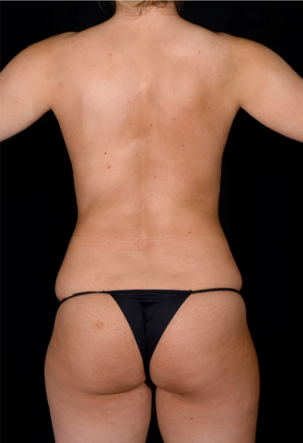 Brazilian-Butt-Lift-Case--5089 | Before Brazilian Butt Lift 1