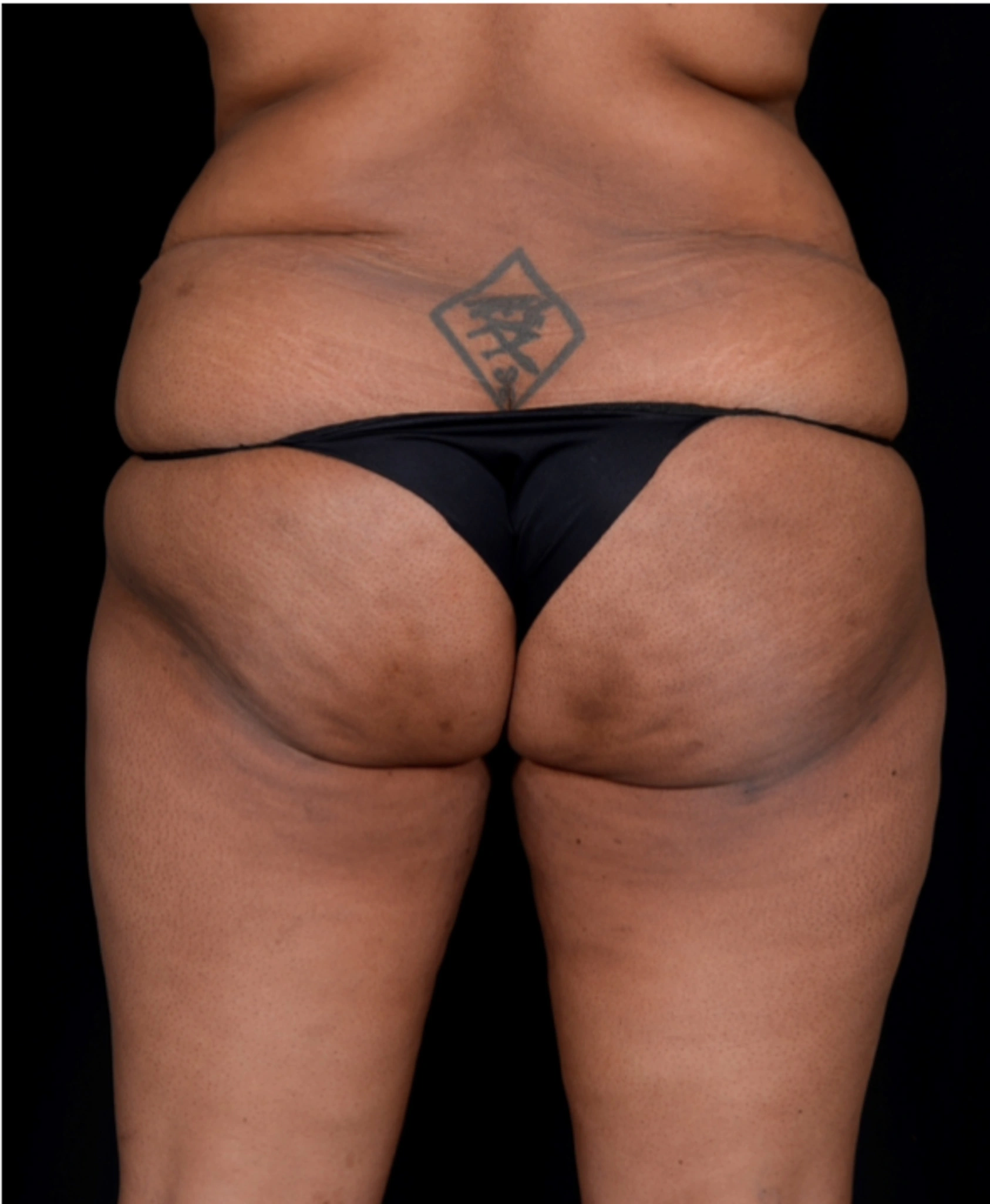 Brazilian-Butt-Lift-Case--7979 | Before Brazilian Butt Lift 1