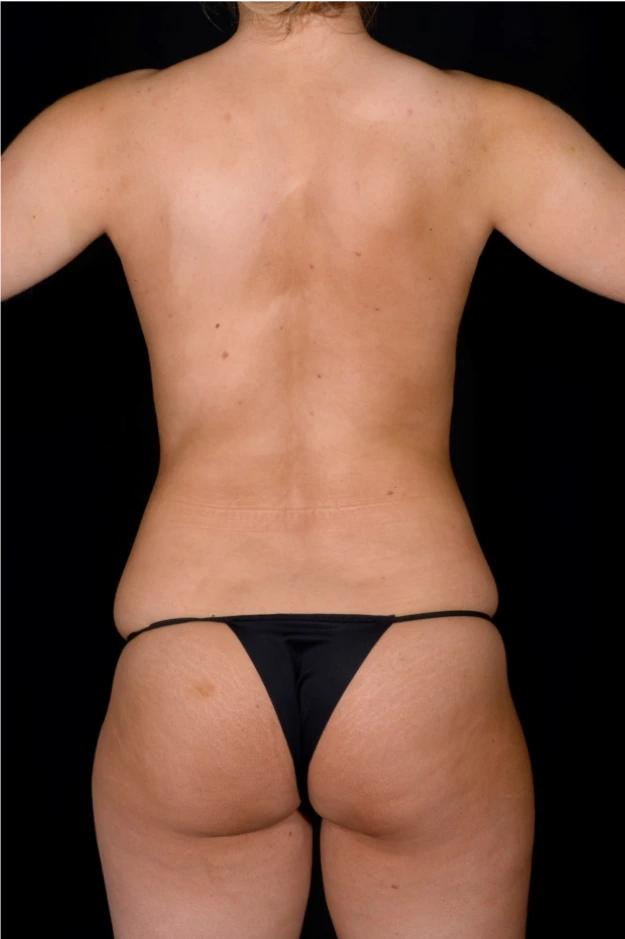 Liposuction-Case--7212 | Before Liposuction 7