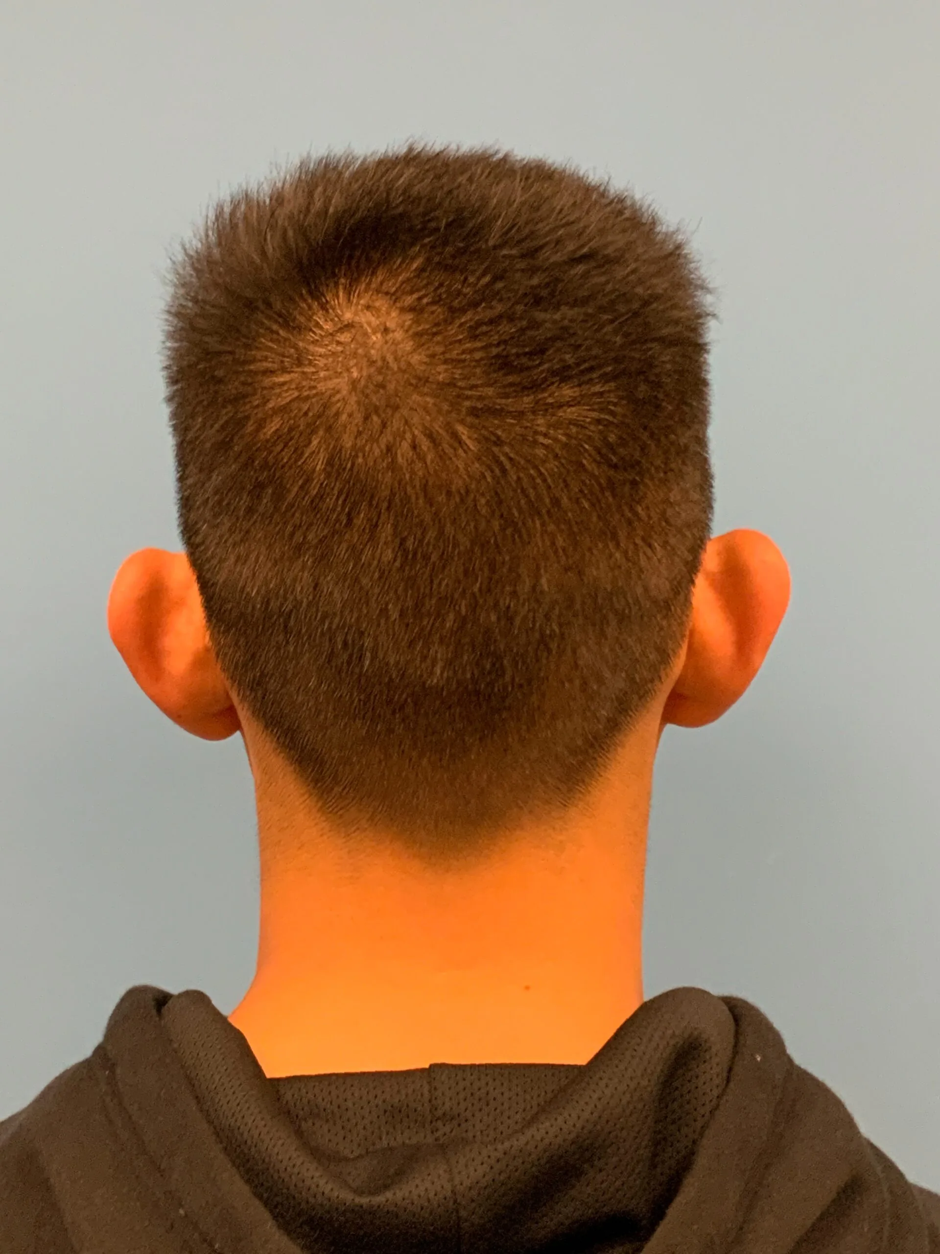 Otoplasty-Case--2681 | Before Otoplasty 6