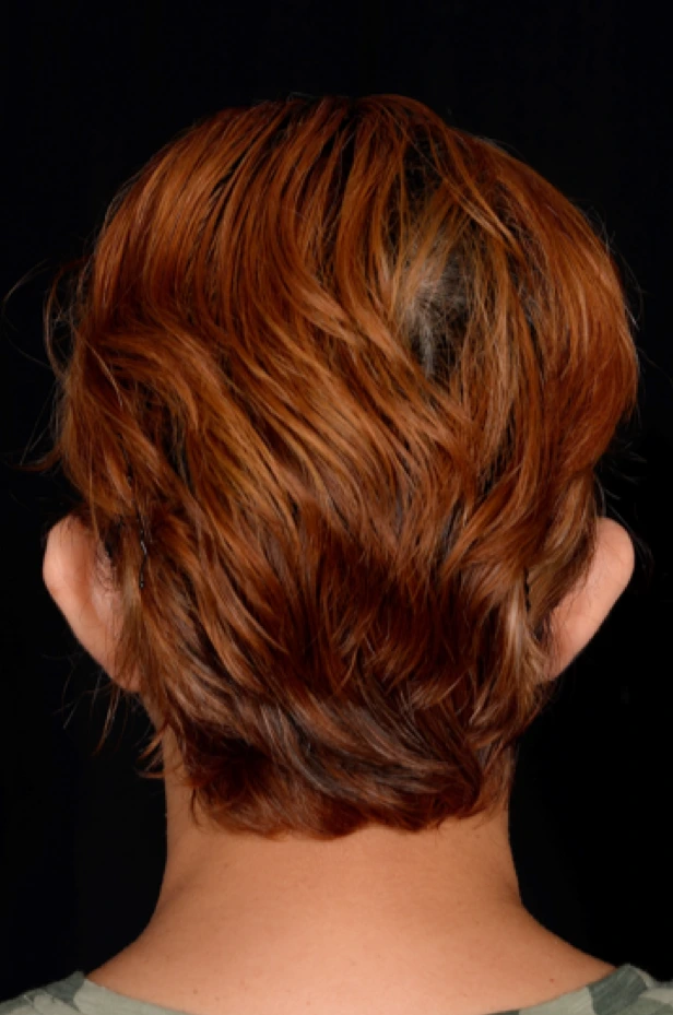 Otoplasty-Case--4655 | Before Otoplasty 5