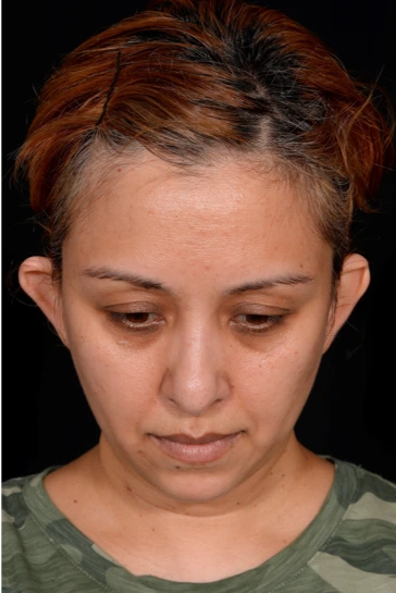 Otoplasty-Case--4655 | Before Otoplasty 4