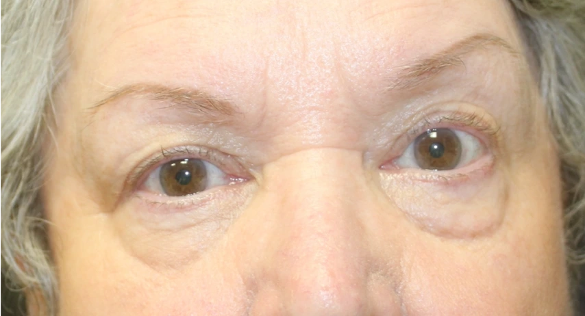 Blepharoplasty-Case--6005 | Before Eyelid Surgery 1