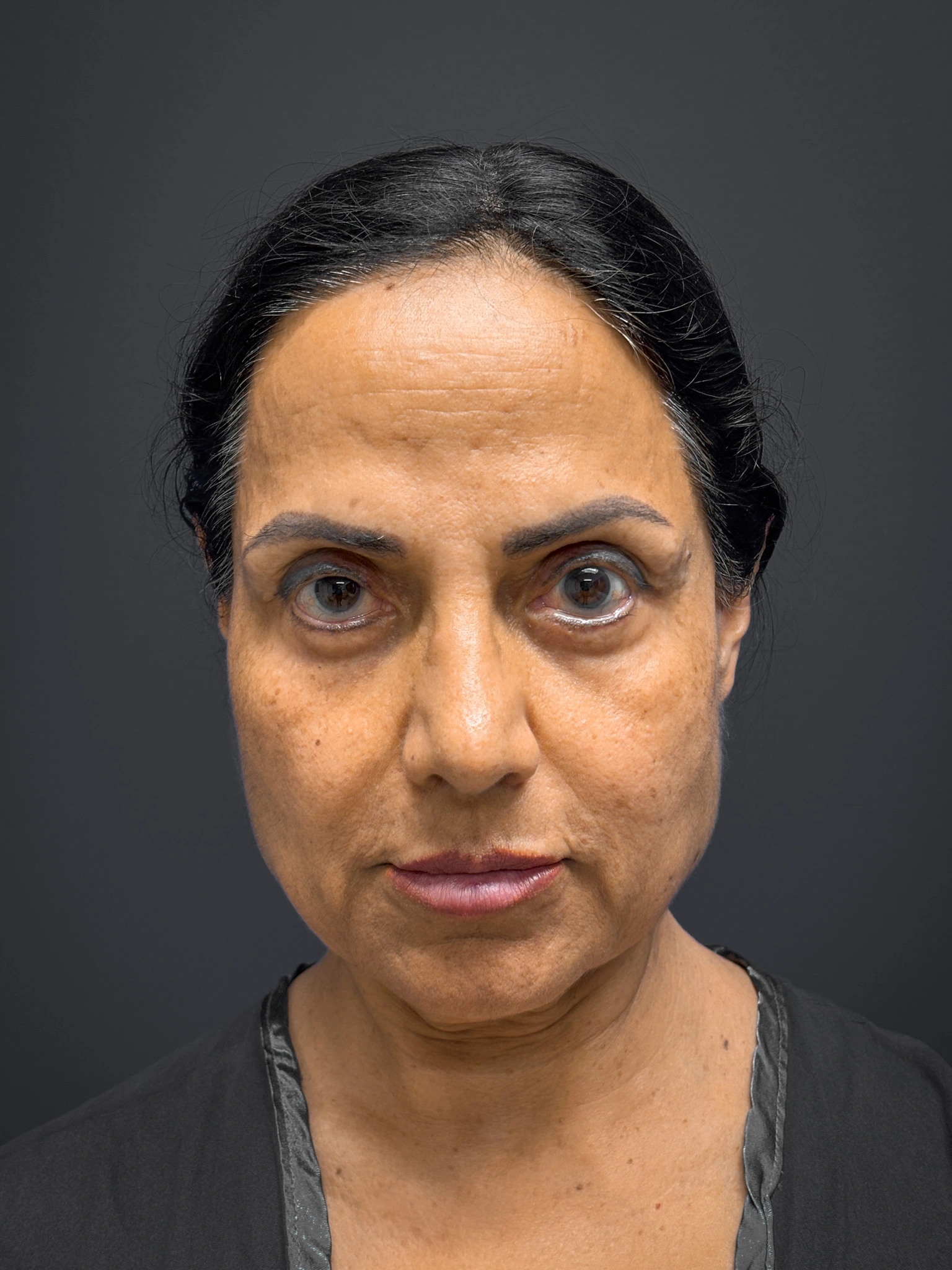 Facelift-Case--7062 | Before Facelift 1