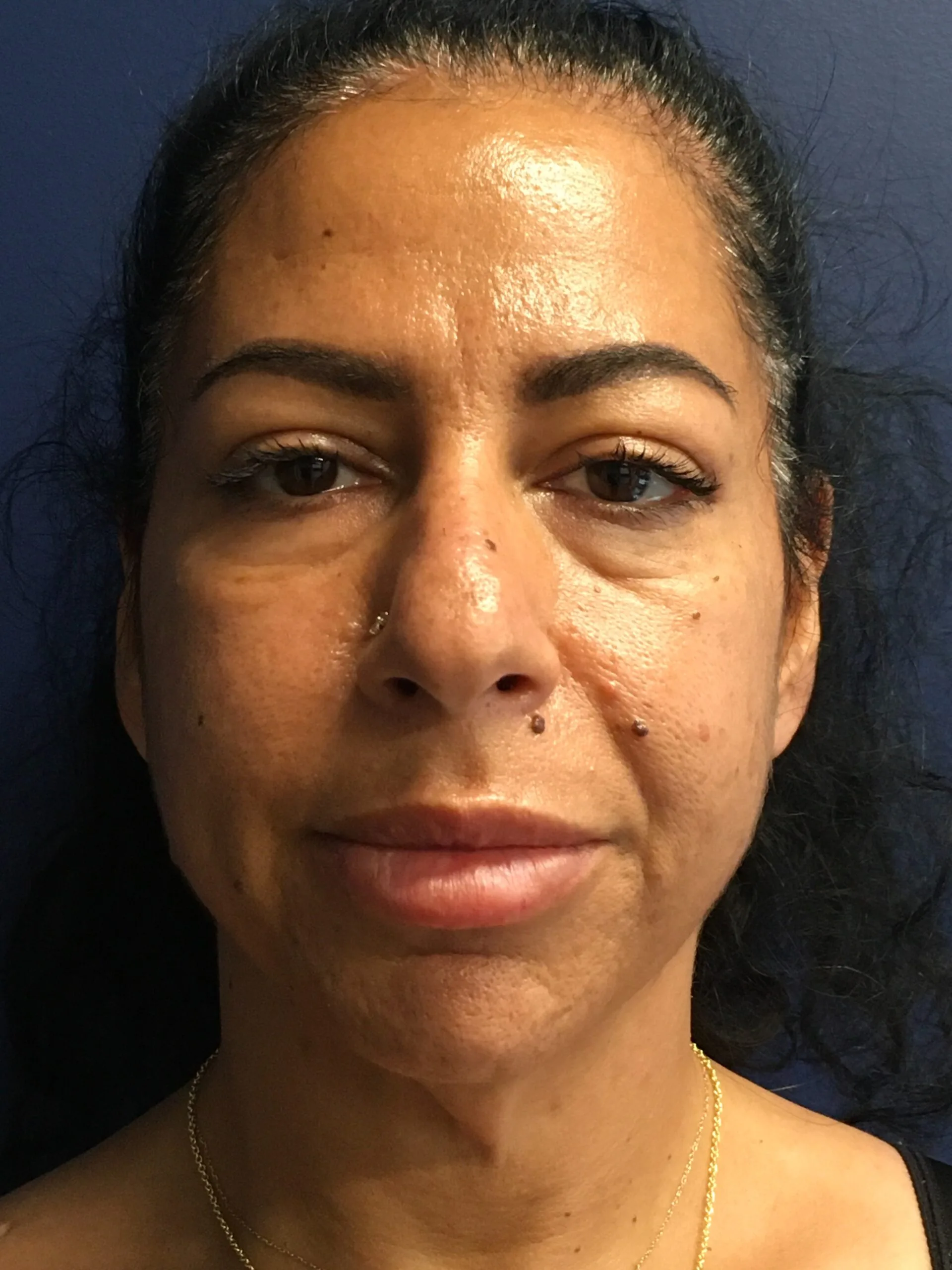 Facelift-Case--8534 | Before Facelift 1