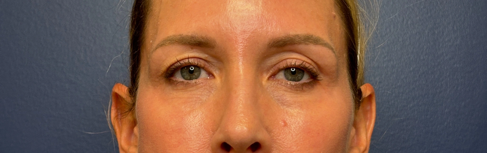 Blepharoplasty-Case--8003 | Before Eyelid Surgery 1