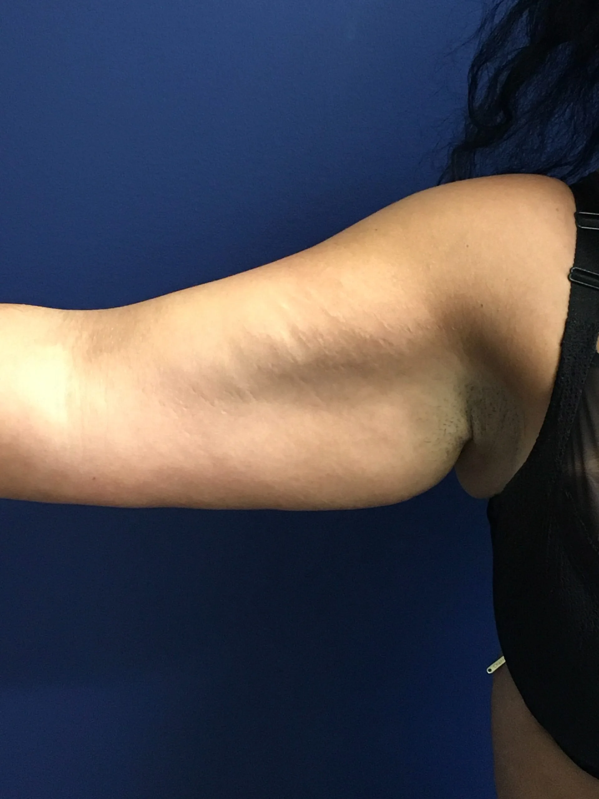 Brachioplasty-Case--1162 | Before Arm Lift 2