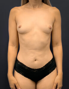 Breast-Augmentation-Case--5691 | Before Breast Augmentation 1