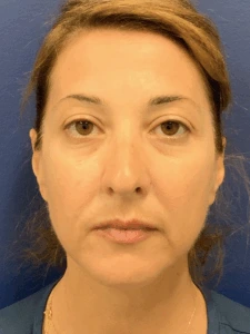 Facelift-Case--8368 | Before Facelift 1