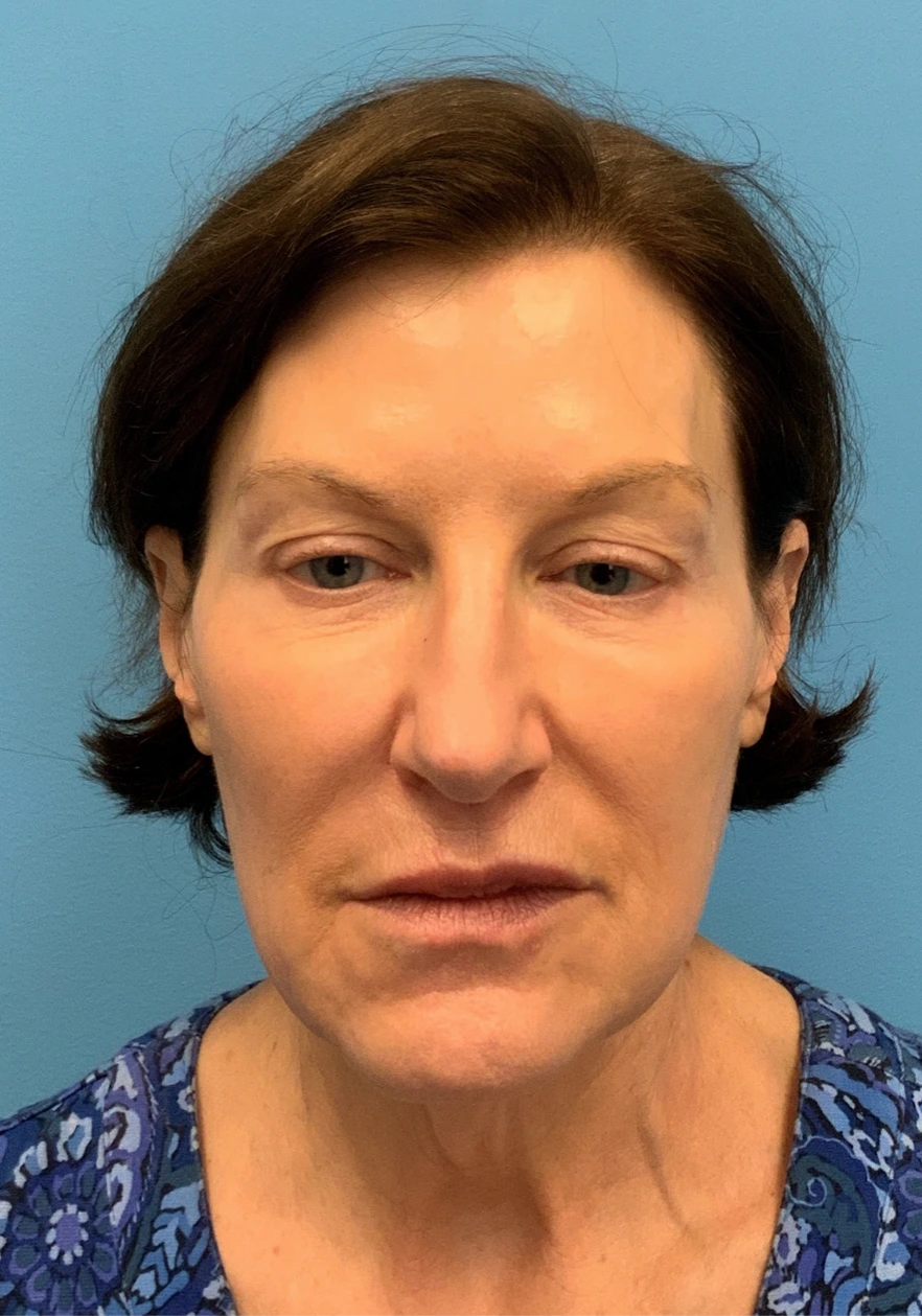 Facelift-Case--6591 | Before Facelift 1