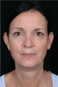 Face-and-Neck-Lift-Case--9403 | Before Neck Lift 1