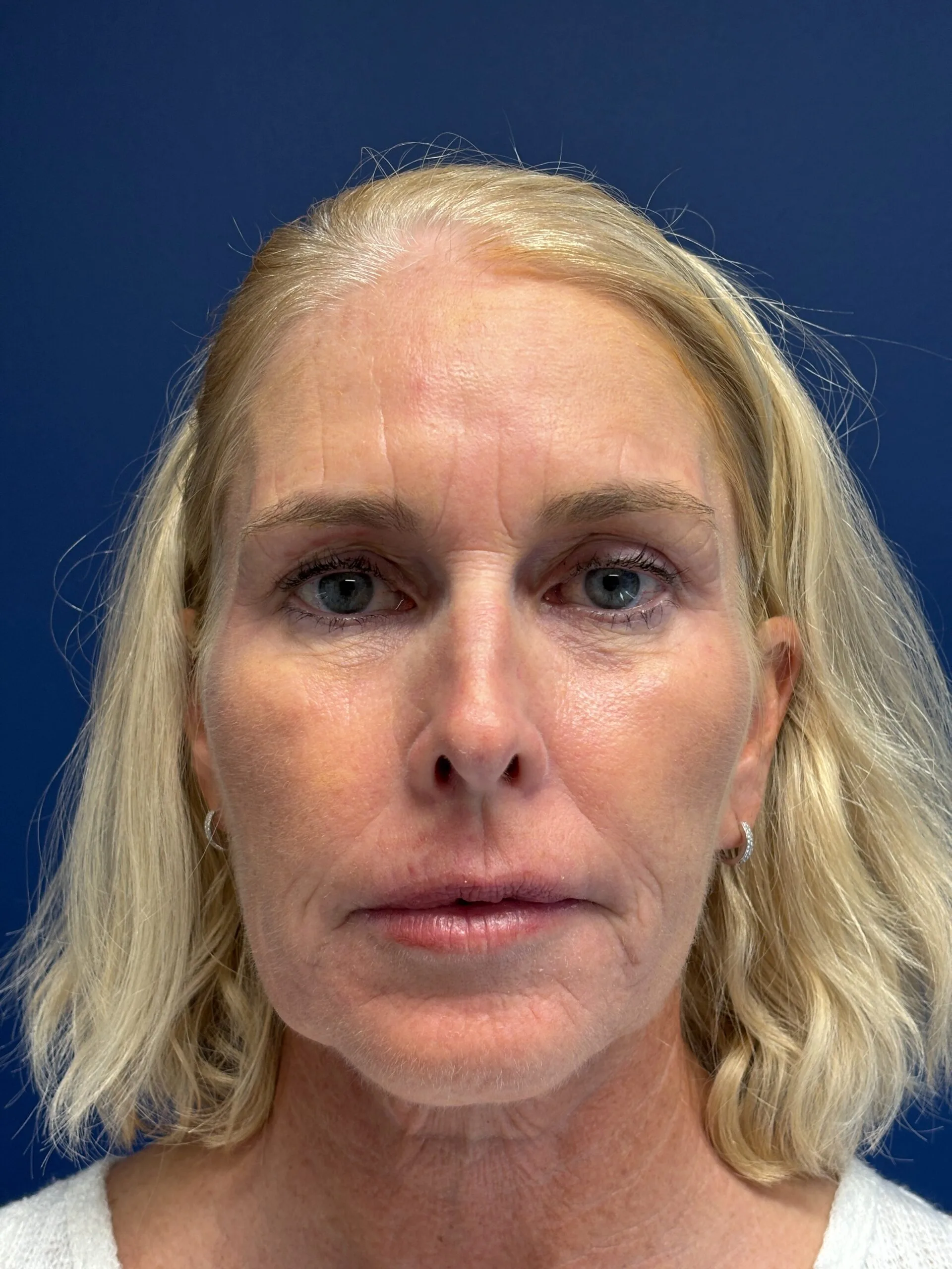 Facelift-Case--2253 | Before Facelift 1