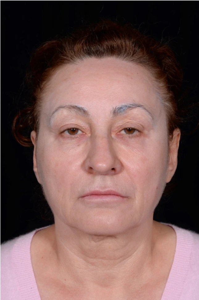 Face-and-Neck-Lift-Case--8423 | Before Facelift 1