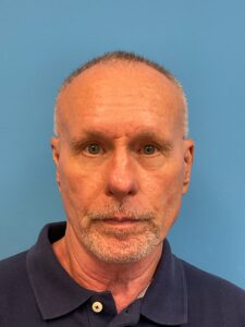 Rhinoplasty-Case--3129 | Before Rhinoplasty 1