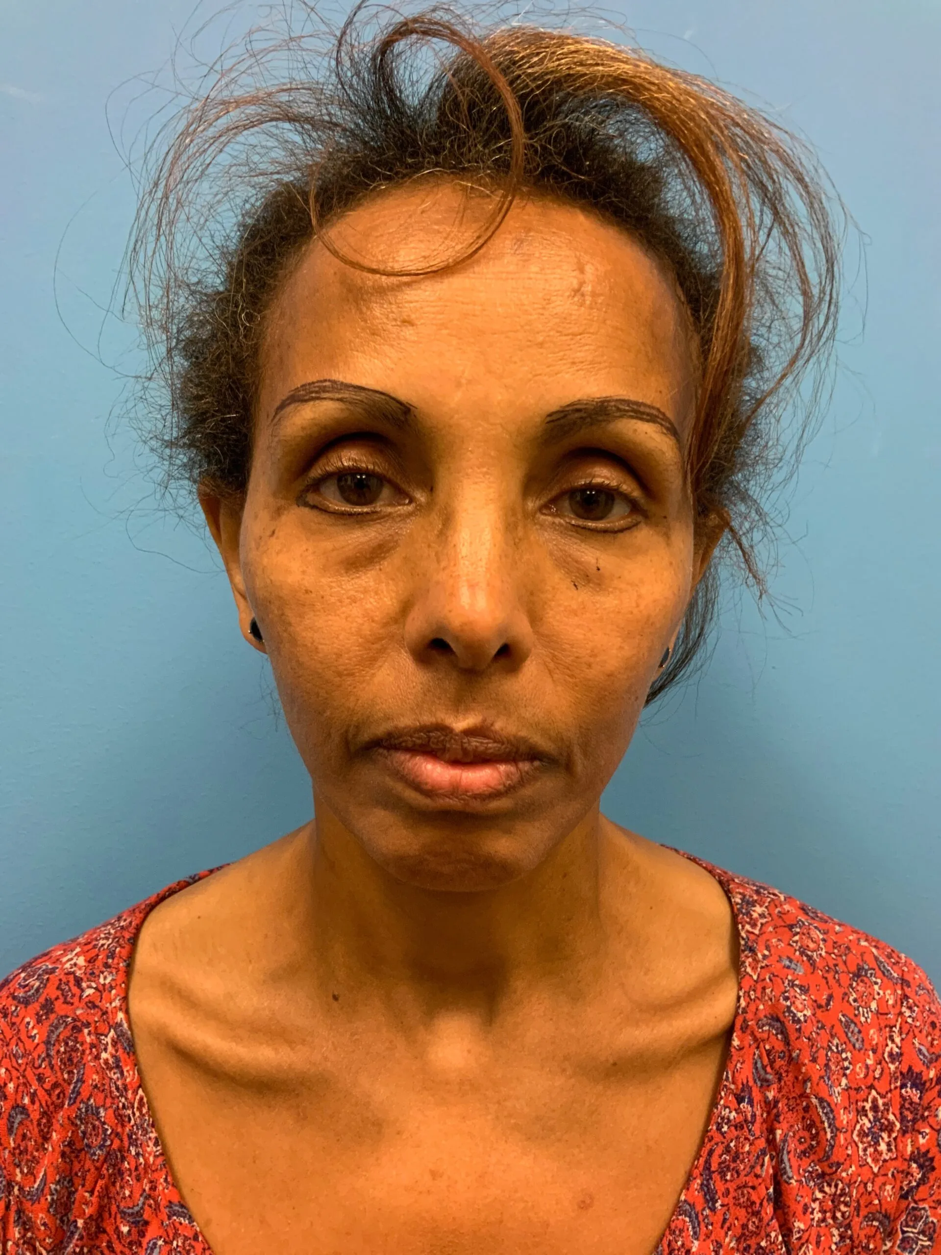 Facelift-Case--1863 | Before Facelift 1