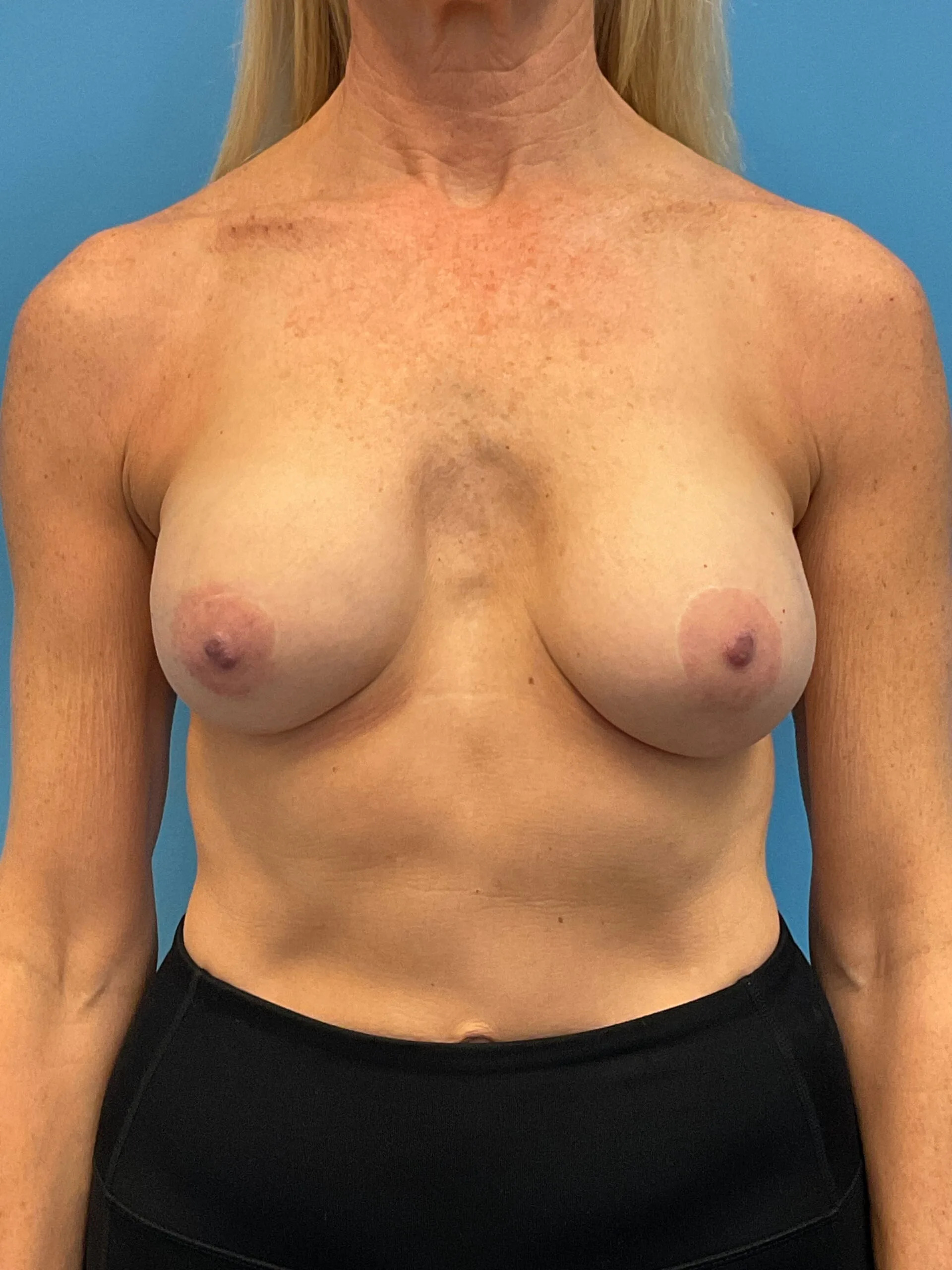 Revision-Breast-Augmentation-Case--9027 | Before Revision Augmentation 1