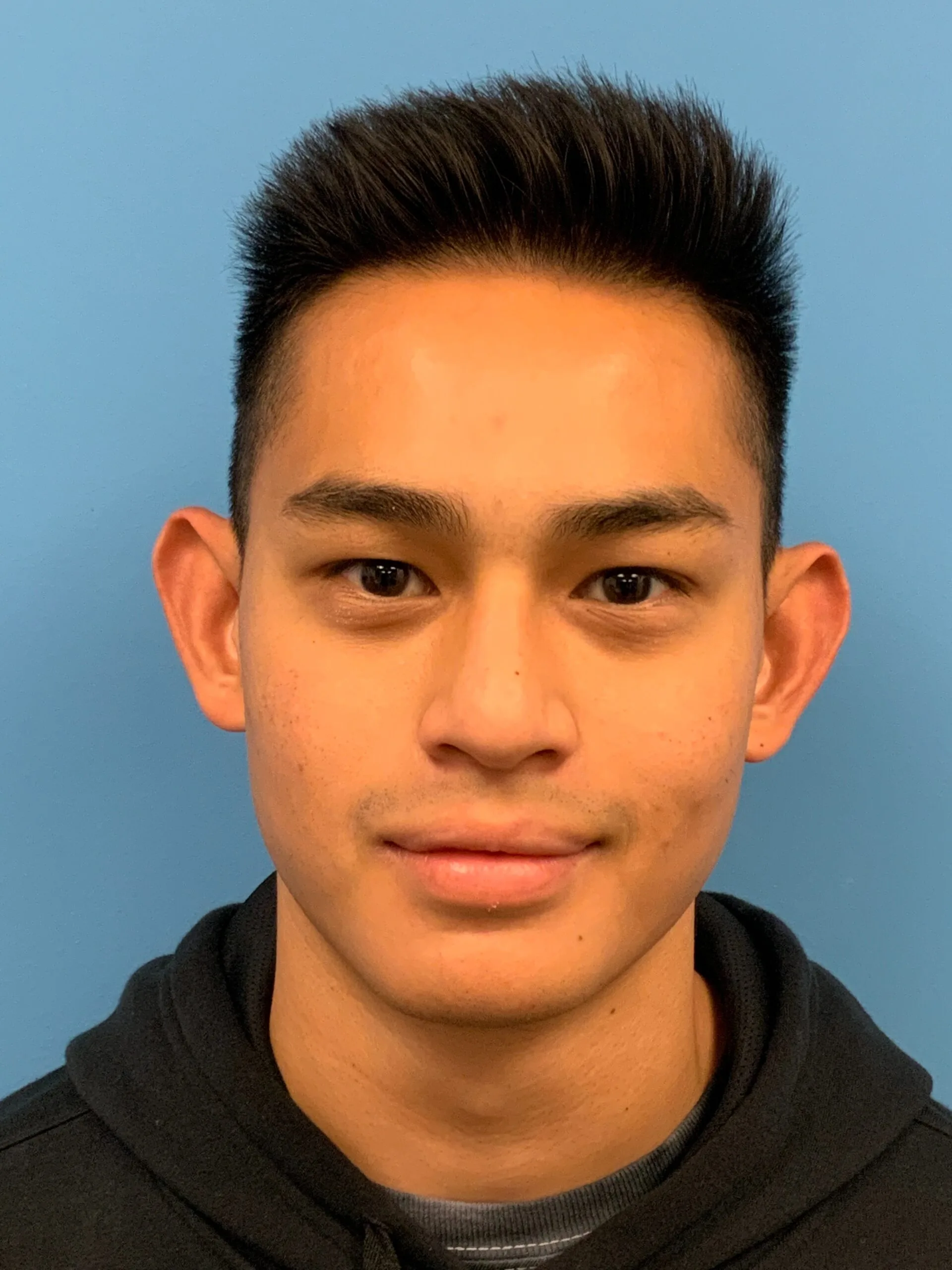 Otoplasty-Case--2681 | Before Otoplasty 1