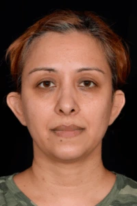 Otoplasty-Case--4655 | Before Otoplasty 1