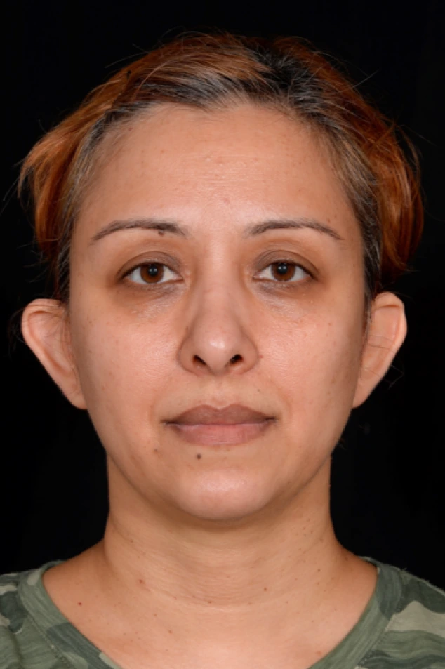 Otoplasty-Case--4655 | Before Otoplasty 1