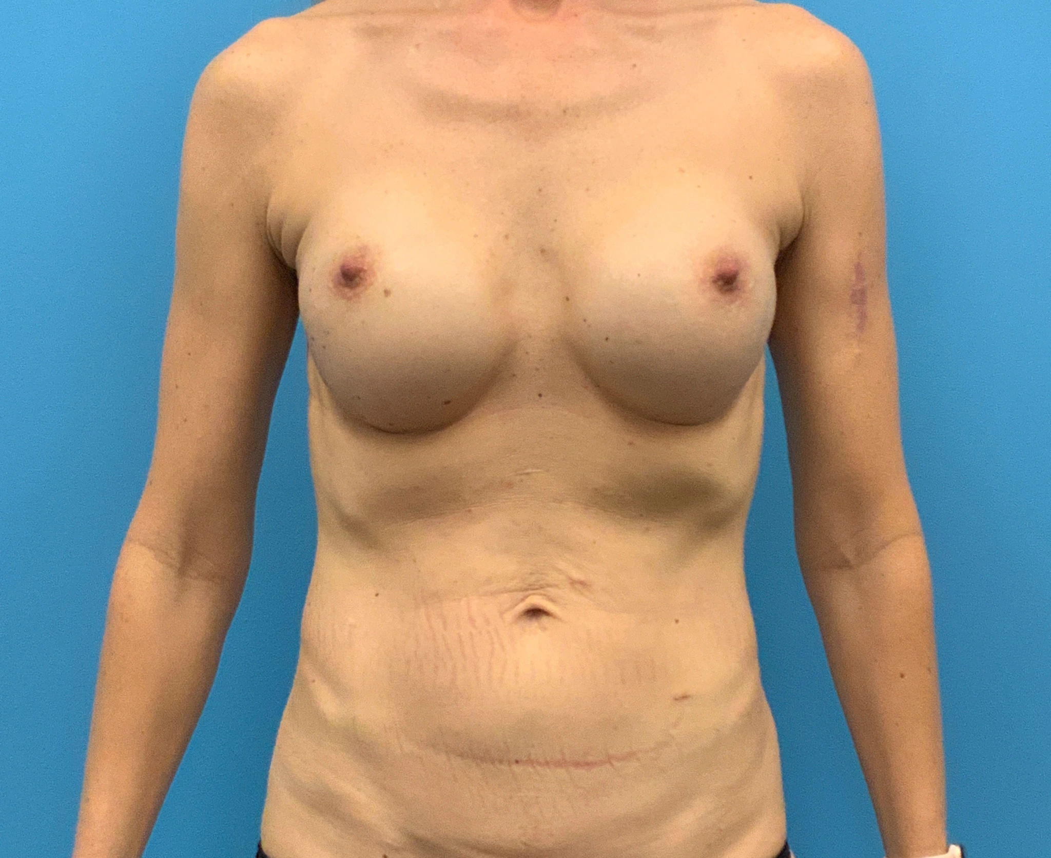 Revision-Breast-Augmentation-Case--4502 | Before Revision Augmentation 1