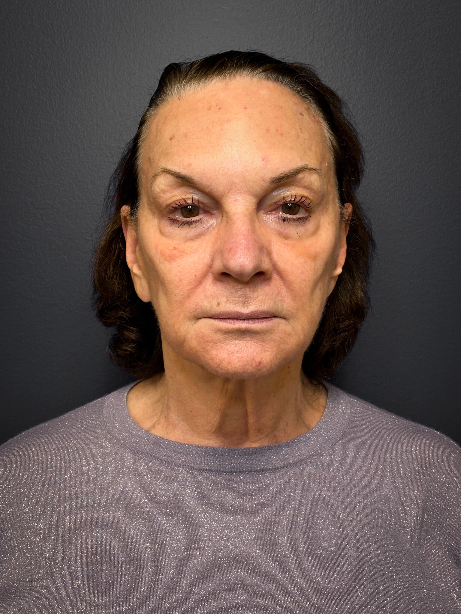 Revision-Facelift-Case--3082 | Before Facelift 1