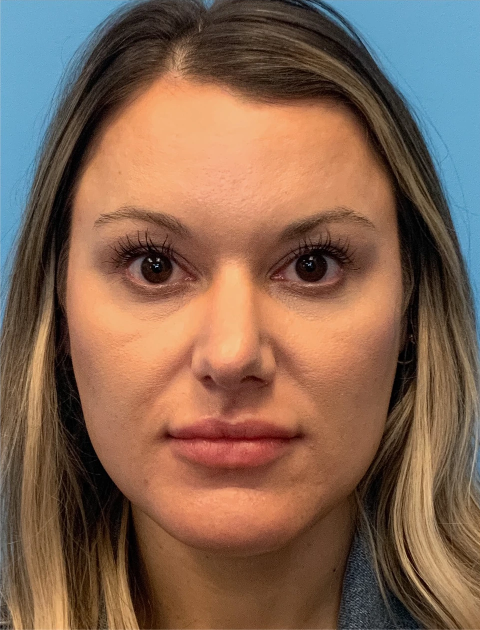 Rhinoplasty-Case--4972 | Before Rhinoplasty 1