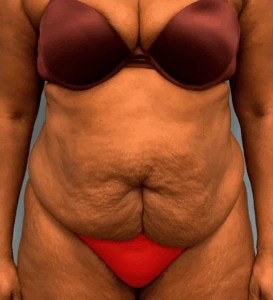 Abdominoplasty-Case--4427 | Before Tummy Tuck 1