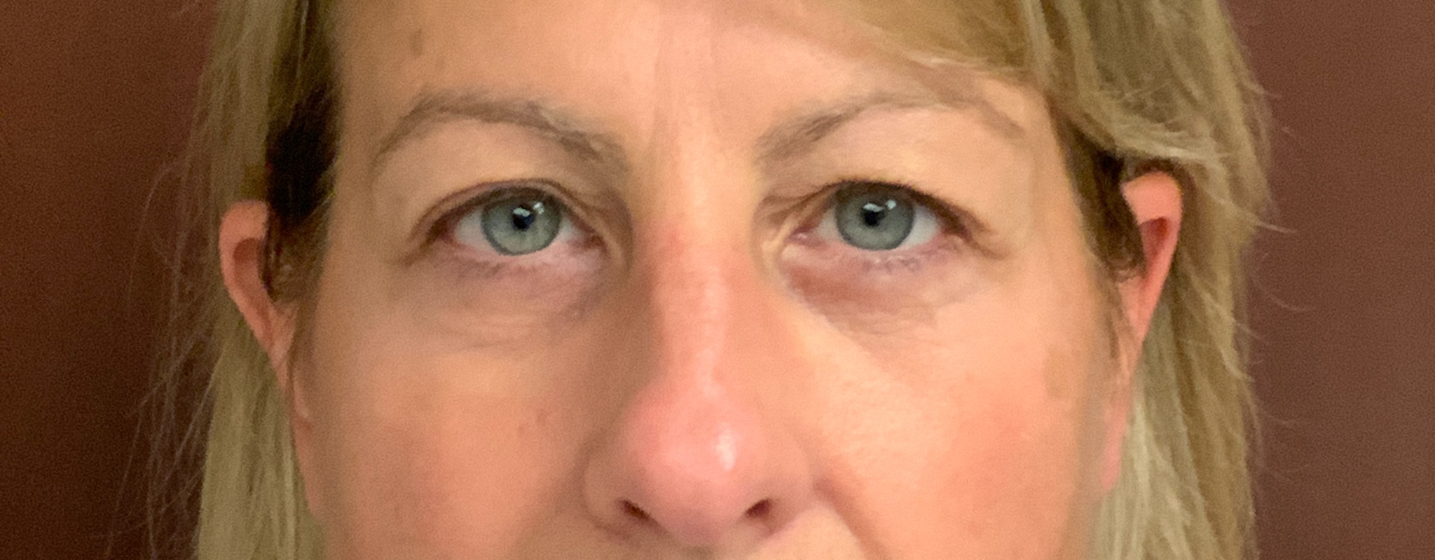 Upper-Blepharoplasty-Case--7202 | Before Eyelid Surgery 1