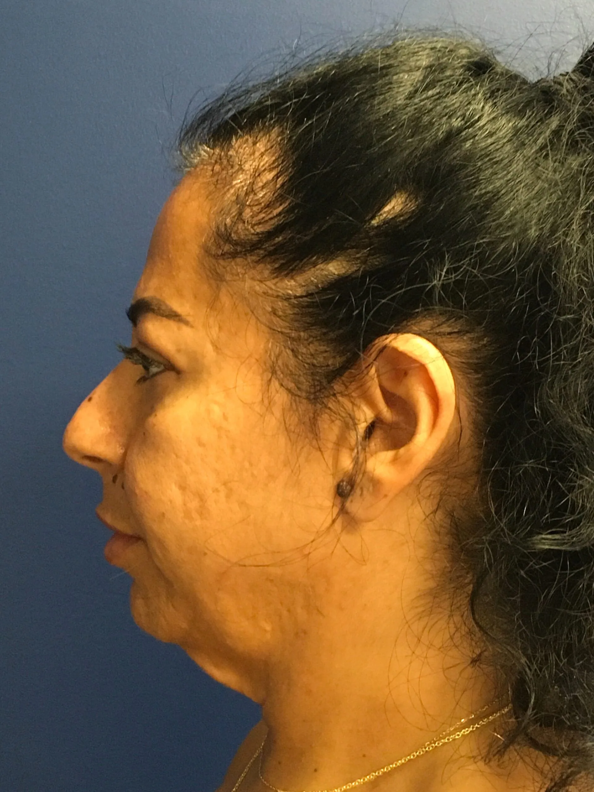 Facelift-Case--8534 | Before Facelift 3