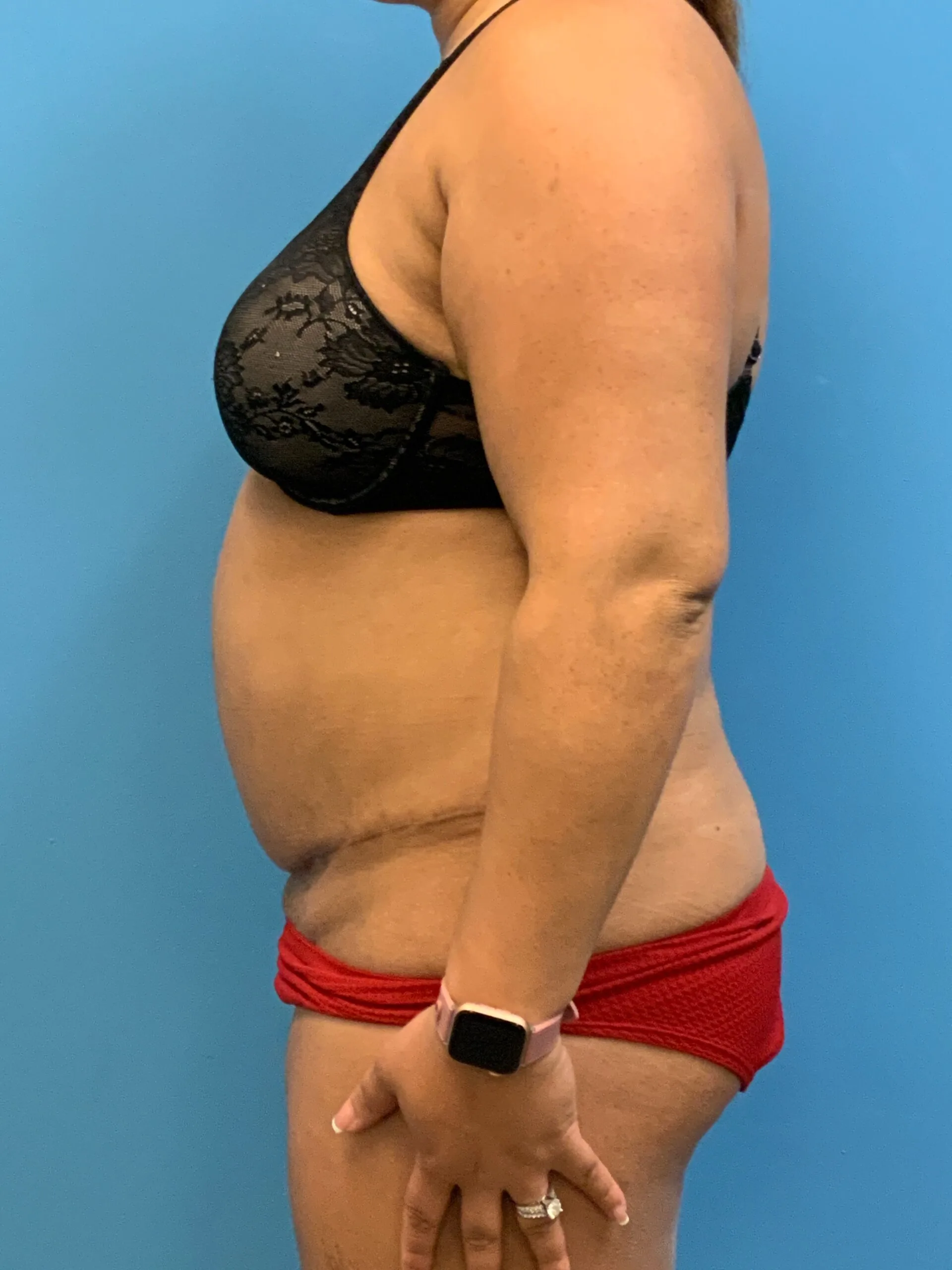 Abdominoplasty-Case--9870 | Before Tummy Tuck 3