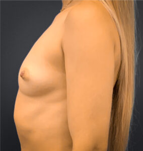 Breast-Augmentation-Case--8208 | Before Breast Augmentation 2