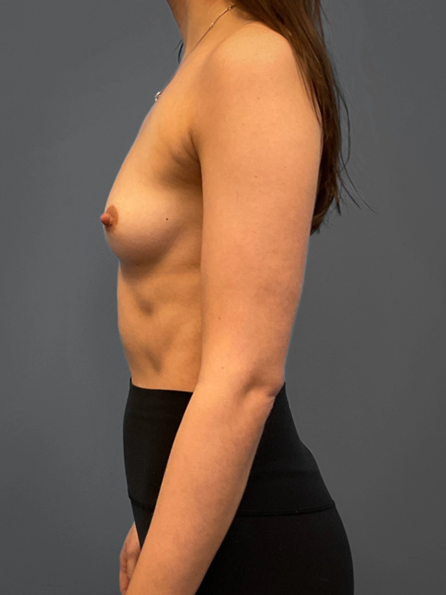 Breast-Augmentation-Case--6687 | Before Breast Augmentation 2
