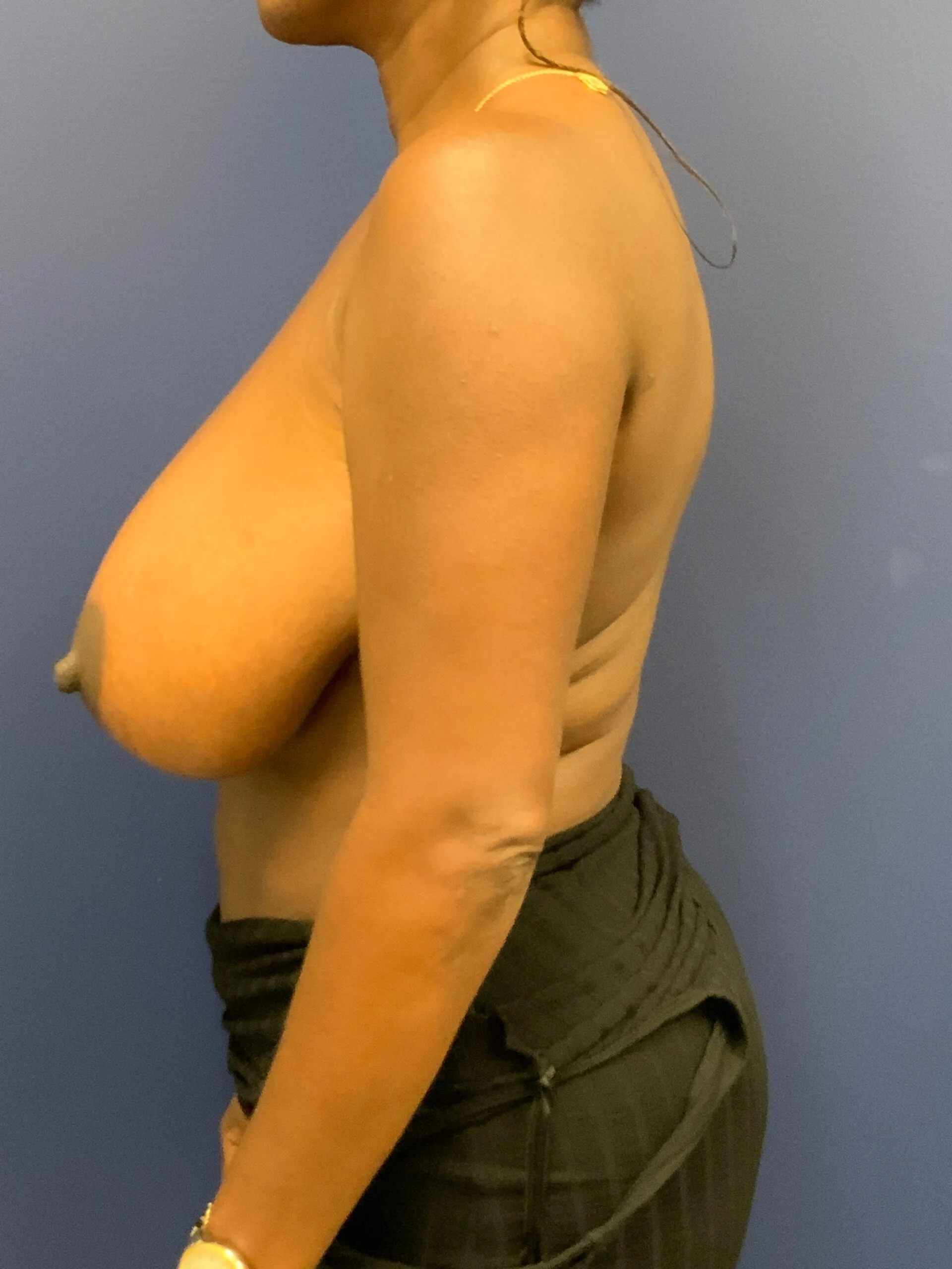 Breast-Reduction-Case--9689 | Before Breast Reduction 3