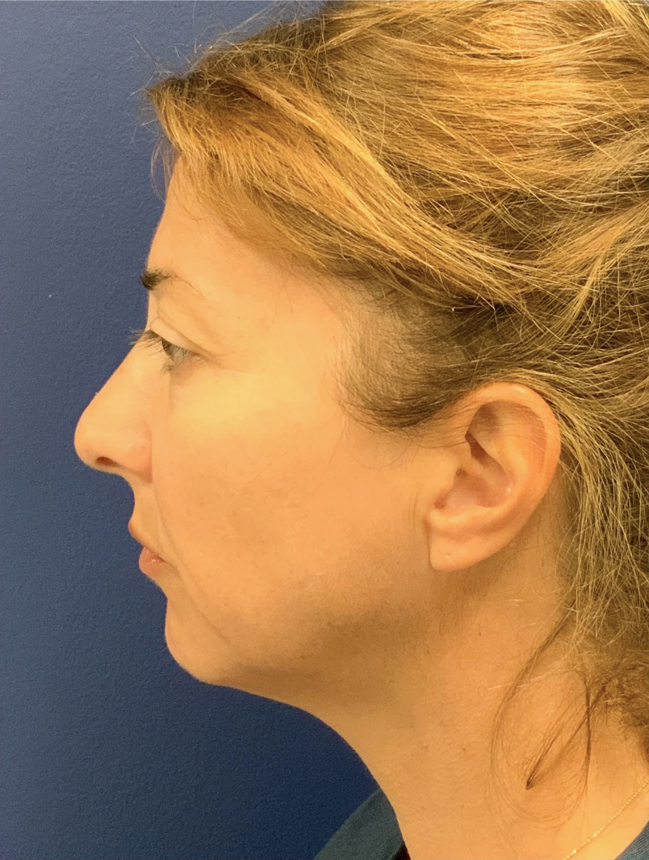 Facelift-Case--8368 | Before Facelift 2