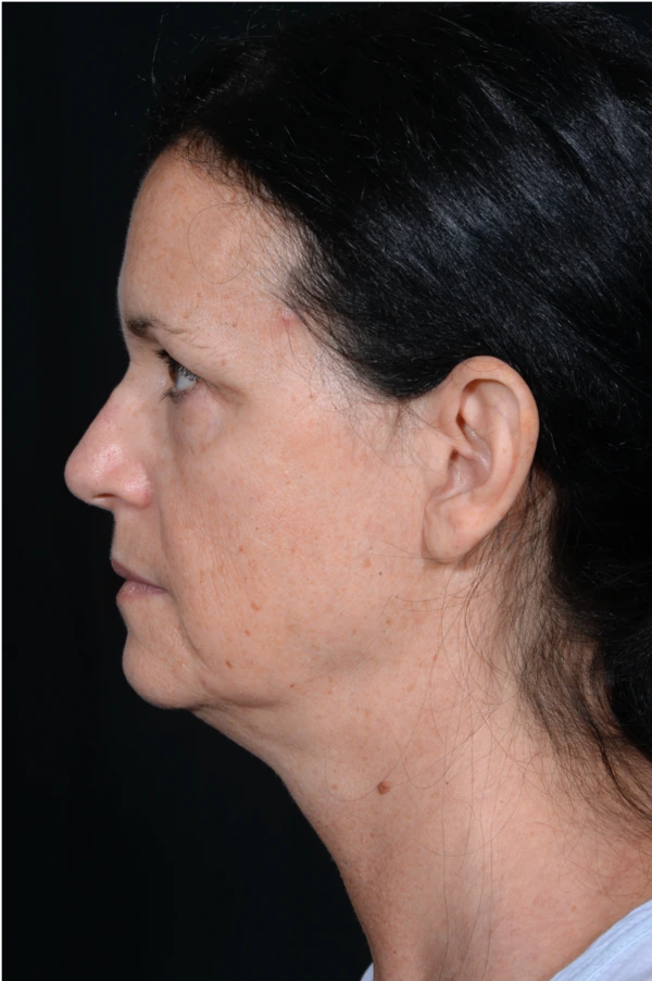 Face-and-Neck-Lift-Case--9403 | Before Facelift 3