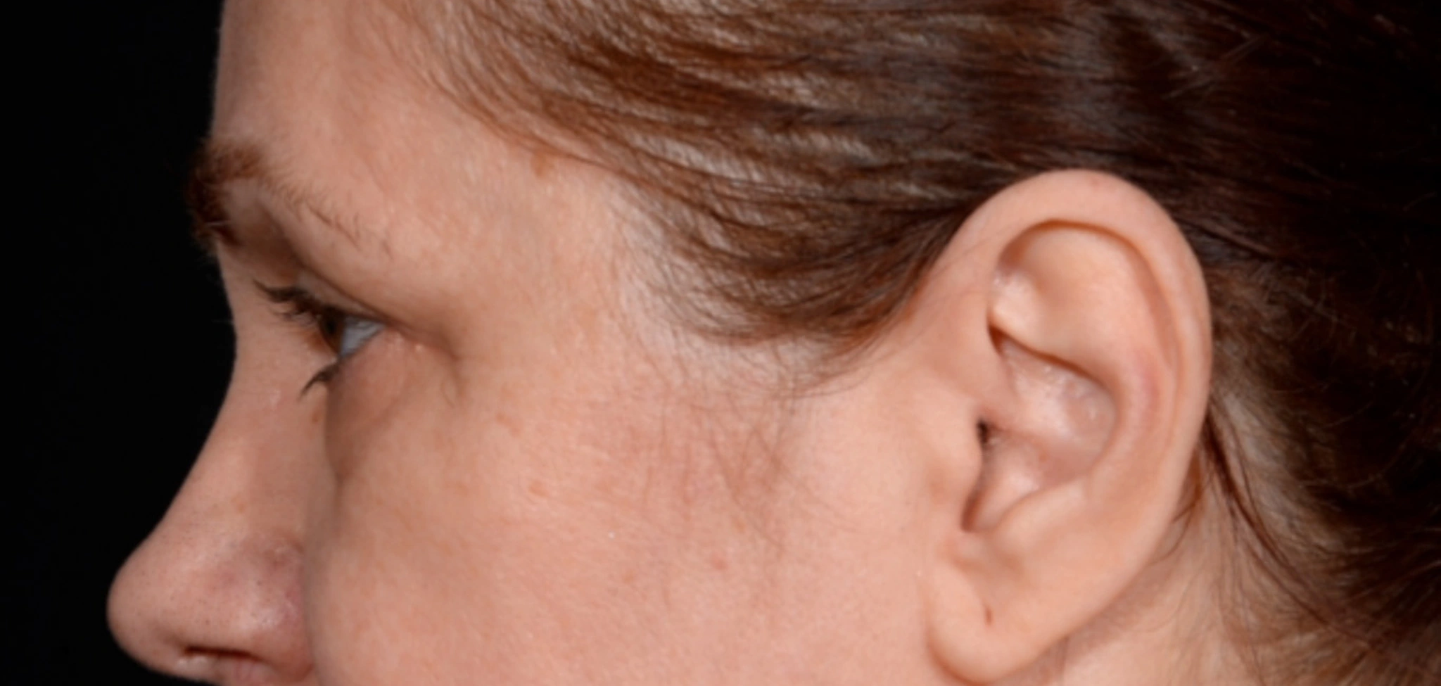 Quad-Blepharoplasty-Case--1851 | Before Eyelid Surgery 2