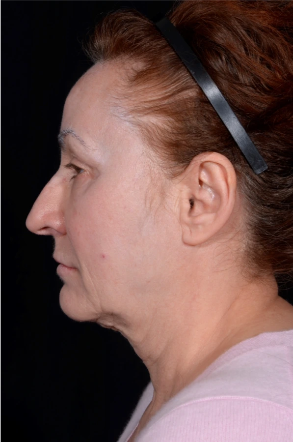 Face-and-Neck-Lift-Case--8423 | Before Facelift 2