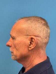 Rhinoplasty-Case--3129 | Before Rhinoplasty 2