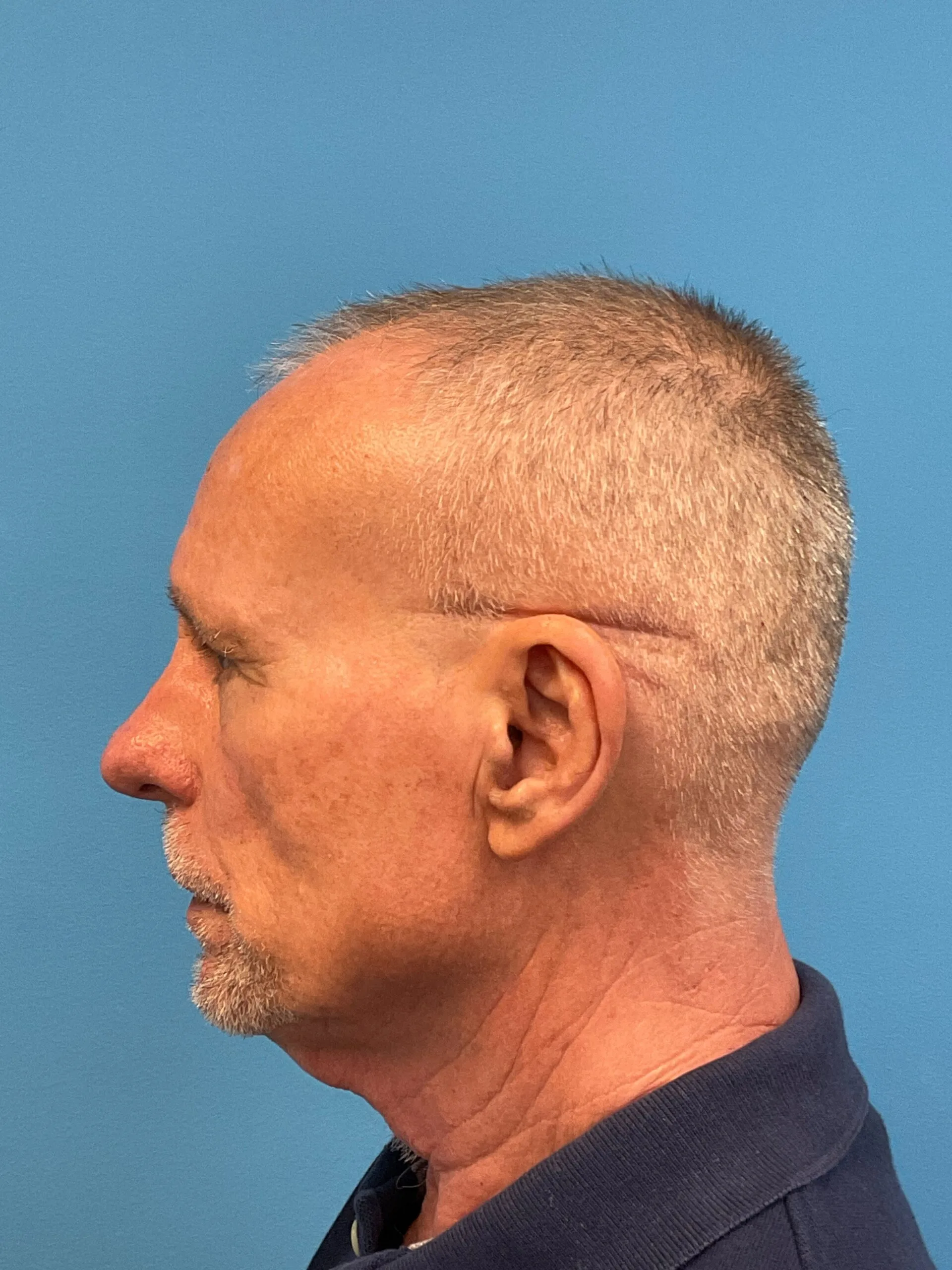 Rhinoplasty-Case--3129 | Before Rhinoplasty 2