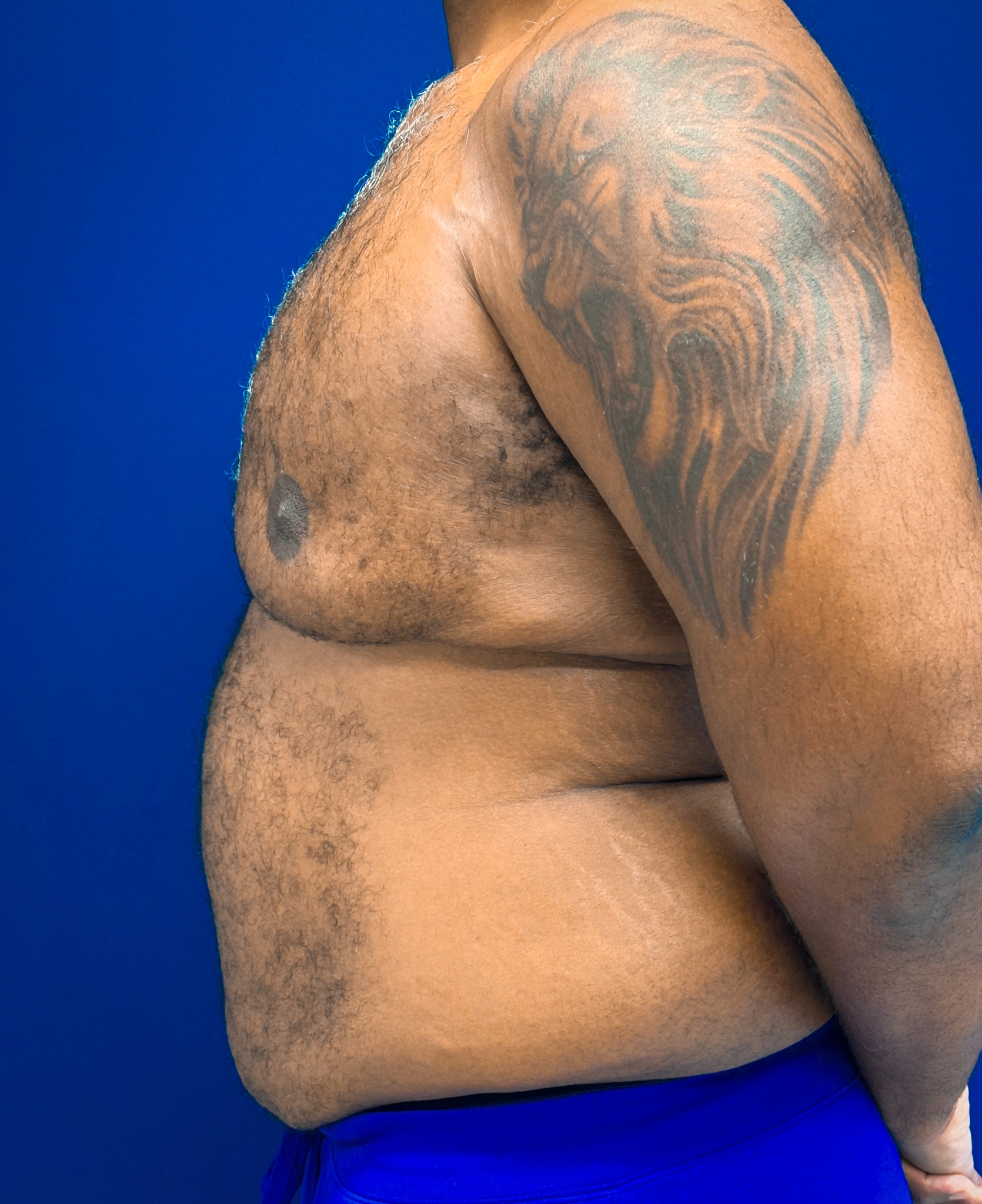 Gynecomastia-Case--4473 | Before Gynecomastia / Male Breast Reduction 3